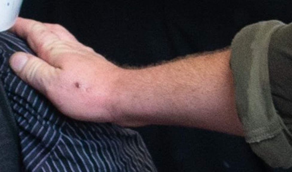 Red Beard has a mole or scar on his right hand